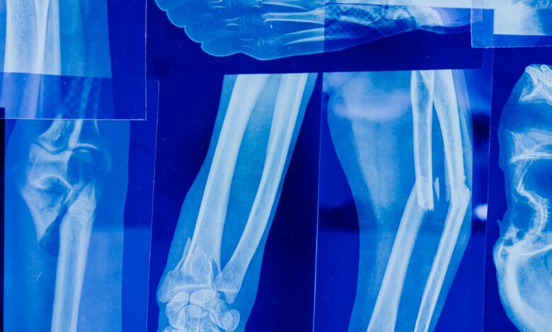 الأشعة السينية (X-Ray)